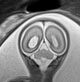 File:Normal brain fetal MRI - 22 weeks (Radiopaedia 50623-56050 Coronal T2 Haste 8).jpg