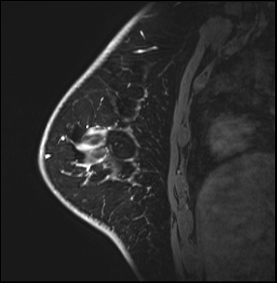 Normal breast MRI - dense breasts (Radiopaedia 80454-93850 I 138).jpg