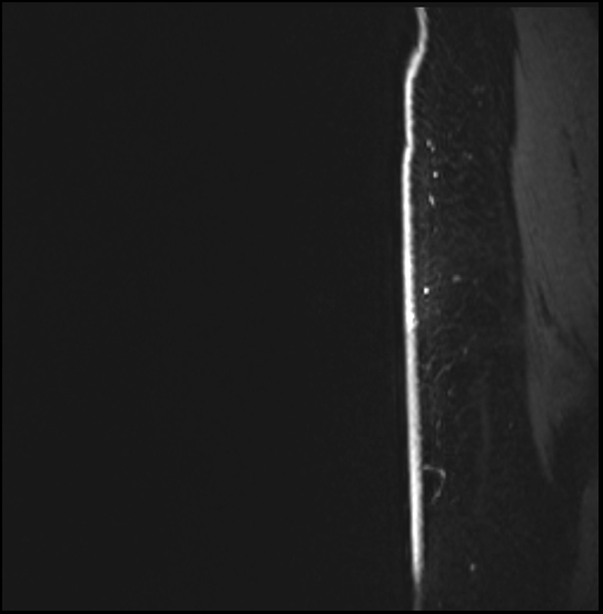Normal breast MRI - dense breasts (Radiopaedia 80454-93850 I 4).jpg
