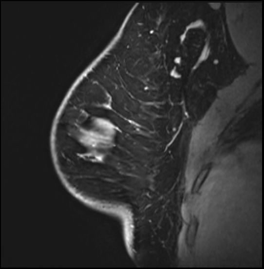 Normal breast MRI - dense breasts (Radiopaedia 80454-93850 I 53).jpg