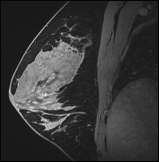 Normal breast MRI - dense breasts (Radiopaedia 80454-93850 I 98).jpg