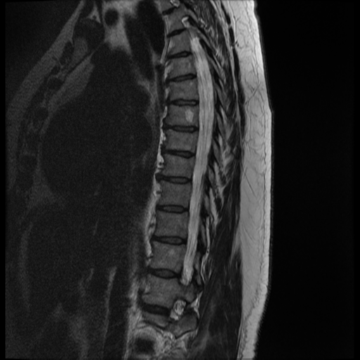 File:Normal cervical and thoracic spine MRI (Radiopaedia 35630-37156 G 9).png
