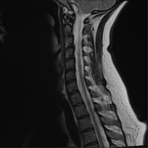 File:Normal cervical spine MRI (including Dixon) (Radiopaedia 42762-45925 Dixon- in-phase 10).png