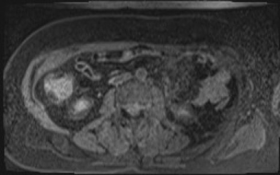 File:Normal hepatobiliary phase liver MRI (Radiopaedia 58968-66230 A 80).jpg