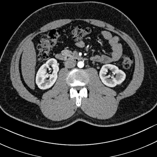 Normal kidneys on 4-phase CT study (Radiopaedia 25889-26038 B 51).jpg