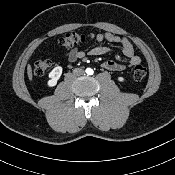 Normal kidneys on 4-phase CT study (Radiopaedia 25889-26038 B 72).jpg