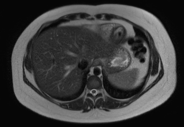 File:Normal liver MRI with Gadolinium (Radiopaedia 58913-66163 Axial T2 27).jpg