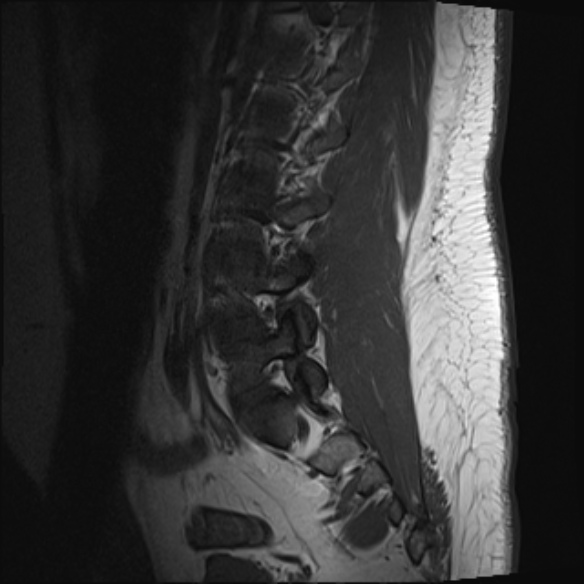 File:Normal lumbar spine MRI (Radiopaedia 47857-52609 Sagittal T1 4).jpg