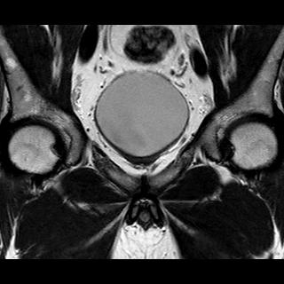 File:Normal prostate (MRI) (Radiopaedia 29986-30535 Coronal T2 5).jpg