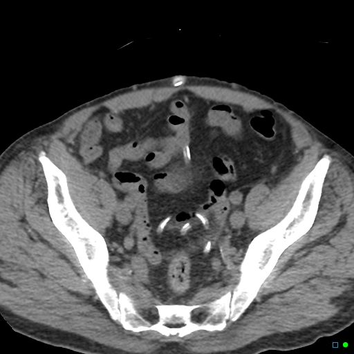 File:Obstructed Tenckhoff peritoneal dialysis catheter (Radiopaedia 37858-39789 Axial non-contrast 5).jpg