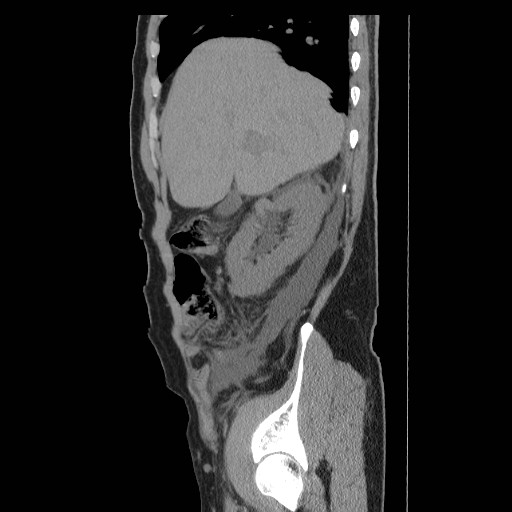 File:Obstructed kidney with perinephric urinoma (Radiopaedia 26889-27066 B 10).jpg