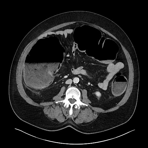Obstructing sigmoid adenocarcinoma (Radiopaedia 58465-65619 A 88).jpg