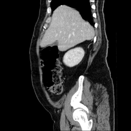 Obstructing ureteric calculus (Radiopaedia 49281-54373 C 70).jpg