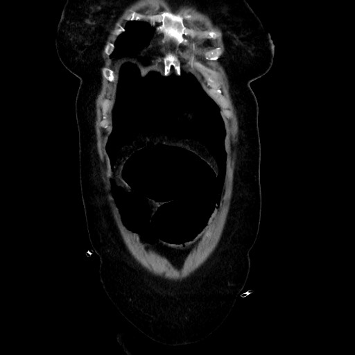 Obstructive distal colonic adenocarcinoma causing cecal perforation (Radiopaedia 86830-102989 C 50).jpg