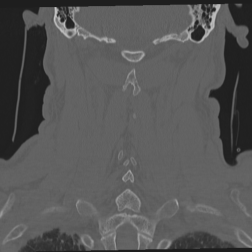File:Occipital condyle fracture (Radiopaedia 33467-34517 Coronal bone window 50).png