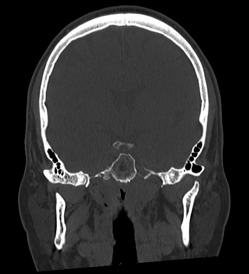 Occipital spur and Currarino type A atlas anomaly (Radiopaedia 87027-103285 Coronal bone window 76).jpg