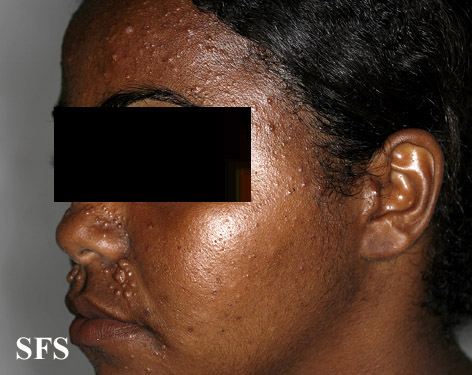 File:Trichoepithelioma (Dermatology Atlas 2).jpg