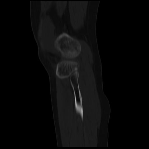 File:ACL avulsion fracture (Radiopaedia 33833-34994 Sagittal bone window 9).jpg