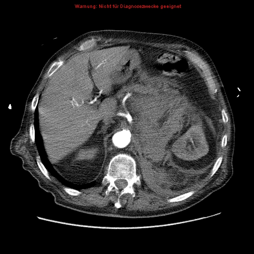 Abdominal aortic aneurysm- extremely large, ruptured (Radiopaedia 19882-19921 Axial C+ arterial phase 16).jpg