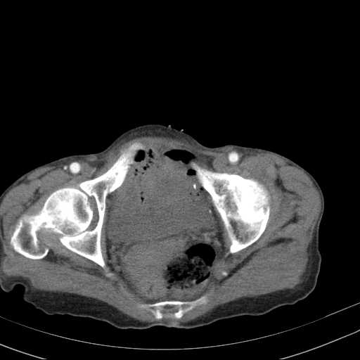 File:Abdominal aortic aneurysm (Radiopaedia 20827-20742 Axial C+ arterial phase 37).jpg