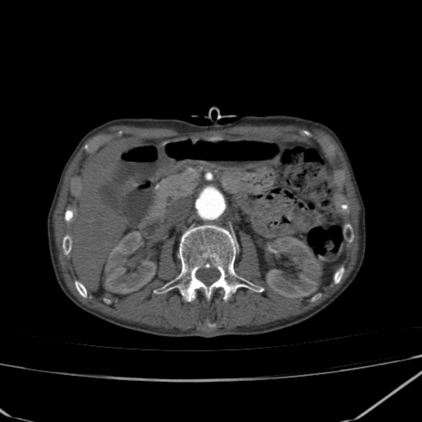Abdominal aortic aneurysm (Radiopaedia 23703-23856 Axial C+ arterial phase 28).jpg