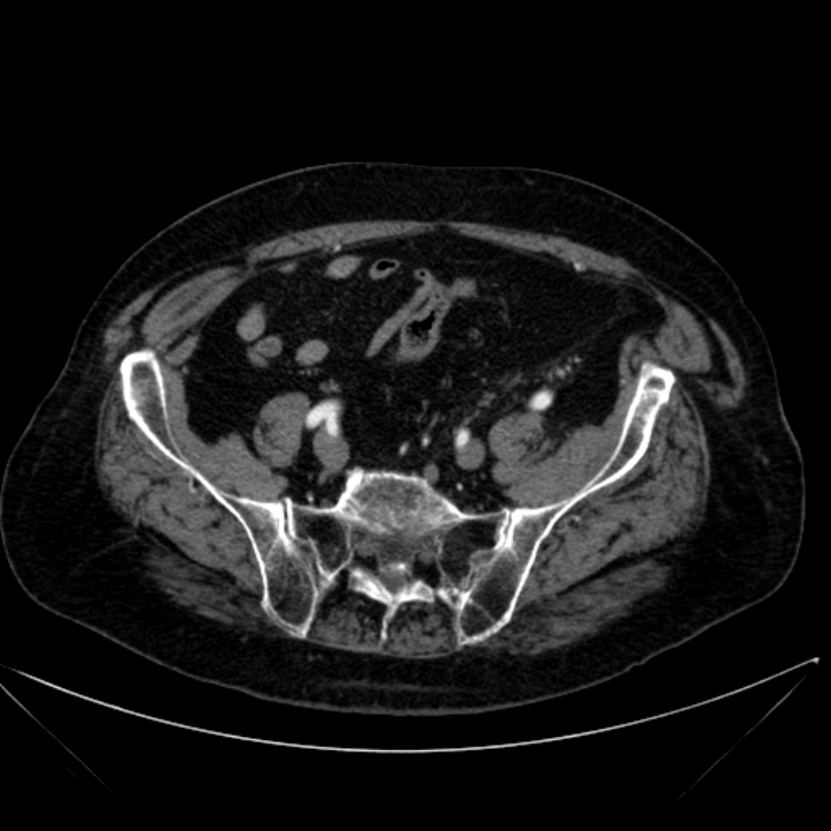 Abdominal aortic aneurysm (Radiopaedia 25855-26001 Axial C+ arterial phase 103).jpg