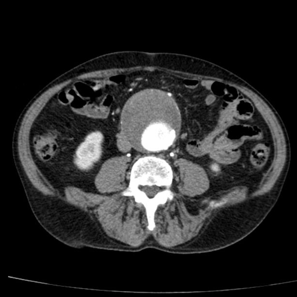 Abdominal aortic aneurysm (Radiopaedia 29248-29660 Axial C+ arterial phase 49).jpg