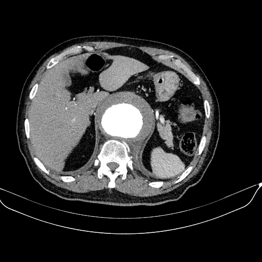 Abdominal aortic aneurysm (Radiopaedia 67117-76452 Axial C+ arterial phase 31).jpg