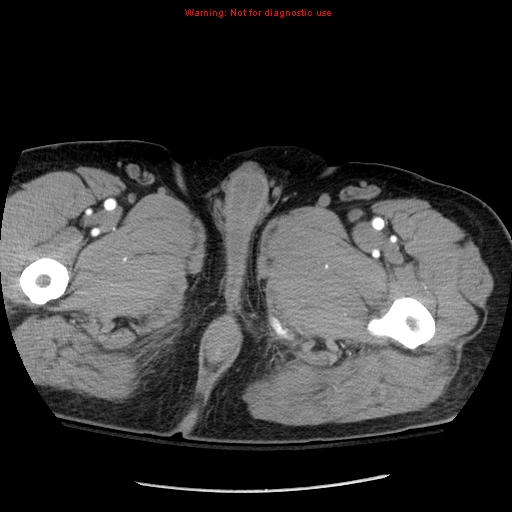 Abdominal aortic aneurysm (Radiopaedia 8190-9038 Axial C+ arterial phase 95).jpg