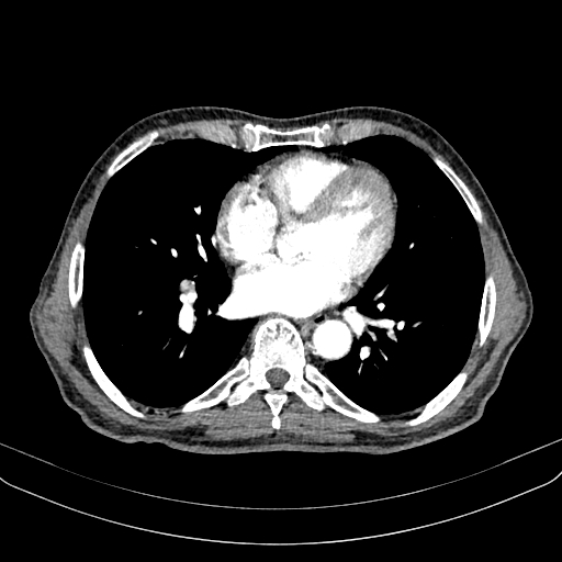 Abdominal aortic aneurysm (Radiopaedia 83581-98689 Axial C+ arterial phase 1).jpg