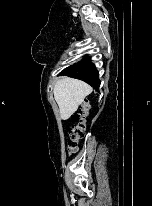 Abdominal aortic aneurysm (Radiopaedia 85063-100606 Sagittal C+ arterial phase 9).jpg