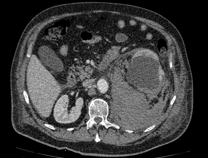 Abdominal aortic aneurysm rupture (Radiopaedia 54179-60362 Axial C+ portal venous phase 25).jpg