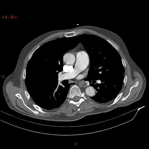 File:Abdominal aortic aneurysm rupture with aortocaval fistula (Radiopaedia 14897-14841 Axial C+ arterial phase 30).jpg