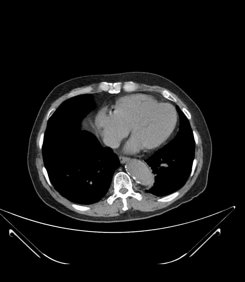 Abdominal aortic aneurysm with thrombus fissuration (Radiopaedia 46218-50618 Axial non-contrast 2).jpg