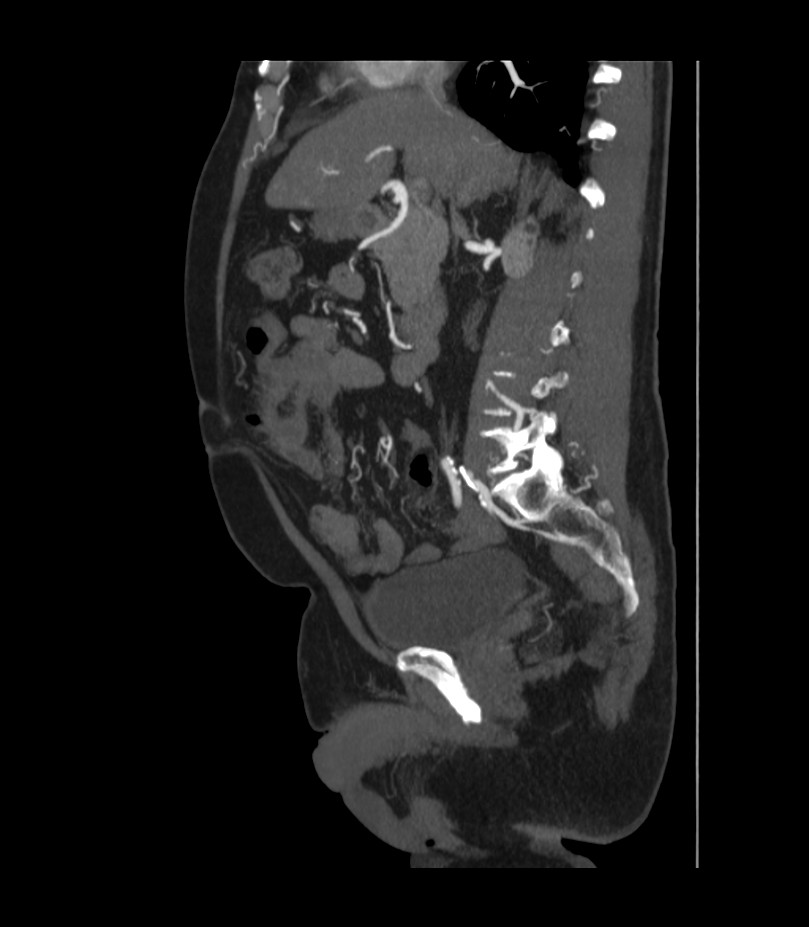 Abdominal aortic aneurysm with thrombus fissuration (Radiopaedia 46218-50618 Sagittal C+ arterial phase 25).jpg