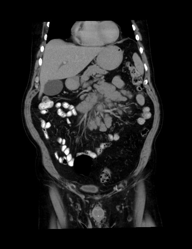 Abdominal lymphoma - with sandwich sign (Radiopaedia 53486-59492 C+ portal venous phase 40).jpg
