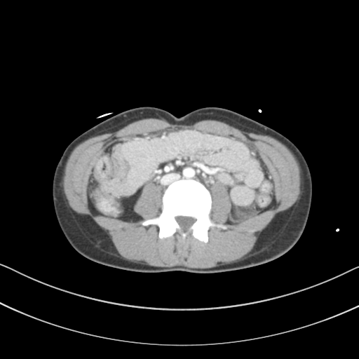 Abdominal multi-trauma - devascularised kidney and liver, spleen and pancreatic lacerations (Radiopaedia 34984-36486 Axial C+ portal venous phase 46).png