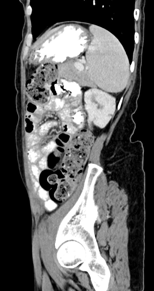 Abdominal wall and retroperitoneal tuberculosis (Radiopaedia 88137-104729 Sagittal C+ portal venous phase 40).jpg
