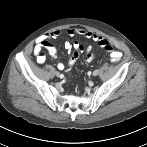 Abdominal wall metastasis from colorectal carcinoma (Radiopaedia 31016-31717 Axial C+ portal venous phase 60).jpg