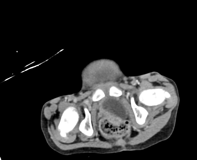 Abdominopelvic rhabdomyosarcoma (Radiopaedia 78356-90984 Axial C+ portal venous phase 152).jpg