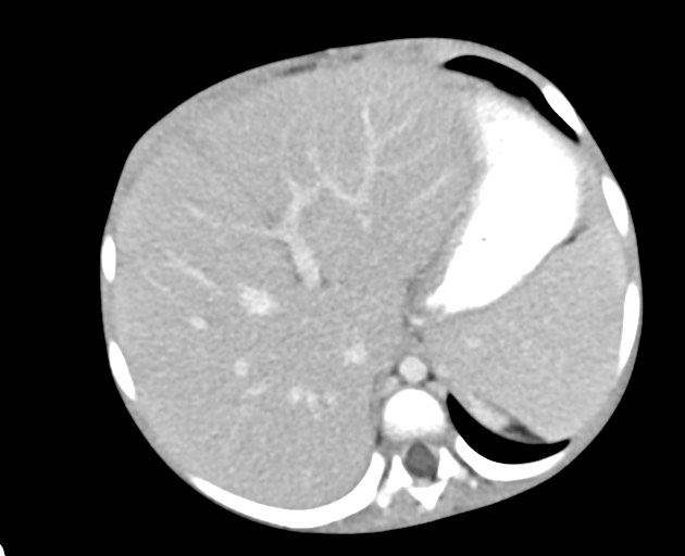 Abdominopelvic rhabdomyosarcoma (Radiopaedia 78356-90984 Axial C+ portal venous phase 49).jpg