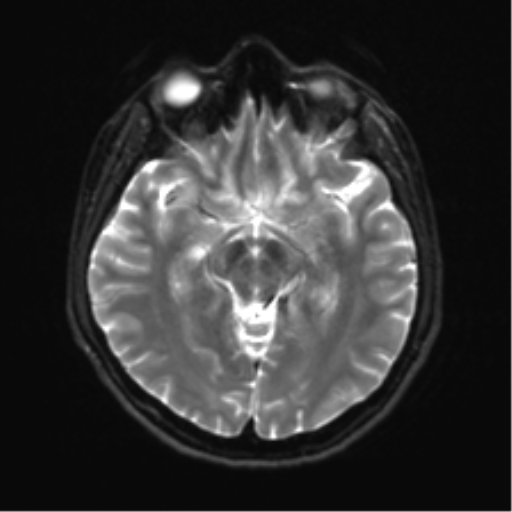 Abducens nerve palsy (Radiopaedia 51069-56648 Axial DWI 11).png