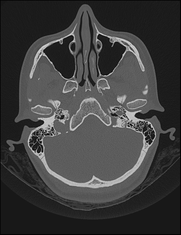 Aberrant right internal carotid artery (Radiopaedia 65191-74198 Axial non-contrast 30).jpg