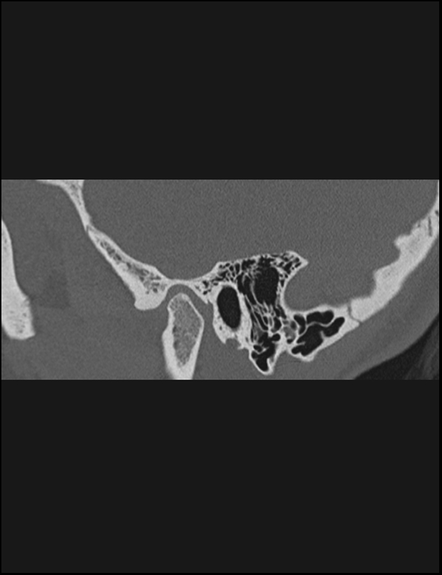Aberrant right internal carotid artery (Radiopaedia 65191-74198 Sagittal non-contrast 32).jpg
