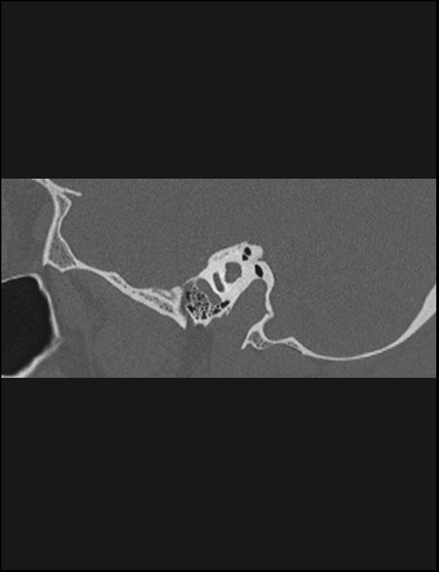 Aberrant right internal carotid artery (Radiopaedia 65191-74198 Sagittal non-contrast 59).jpg