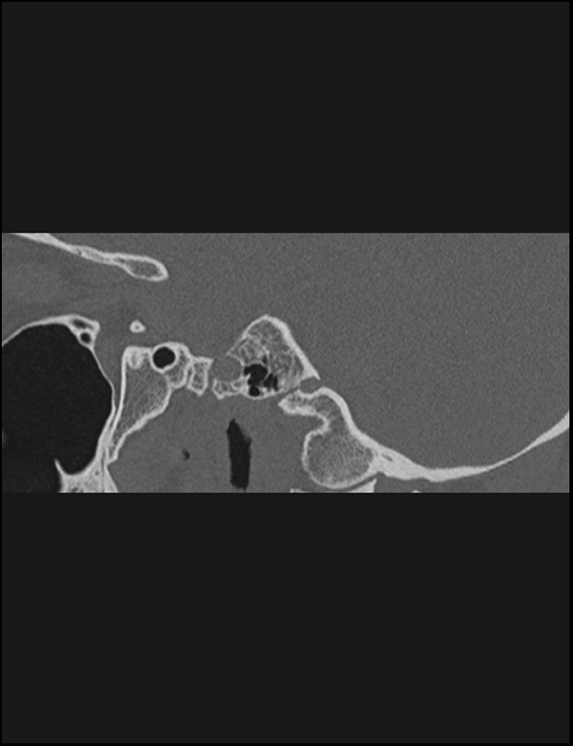 Aberrant right internal carotid artery (Radiopaedia 65191-74198 Sagittal non-contrast 78).jpg