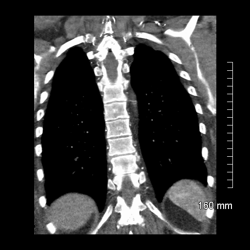 Aberrant right subclavian artery stenosis (Radiopaedia 52656-58670 B 67).jpg