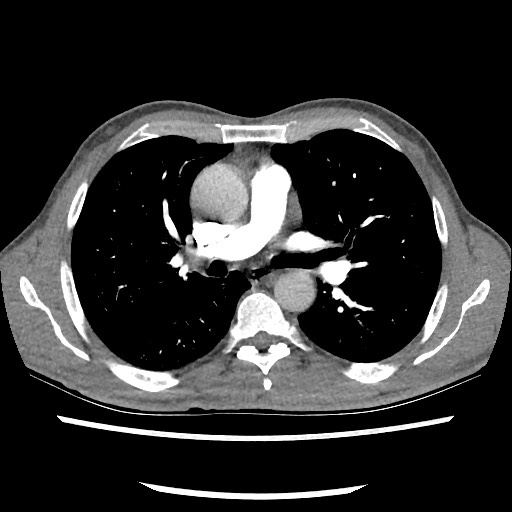 Accessory left horizontal fissure with lingular pneumonia (Radiopaedia 53763-59843 Axial C+ CTPA 44).jpg