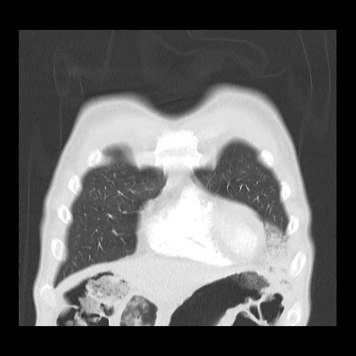 Accessory left horizontal fissure with lingular pneumonia (Radiopaedia 53763-59843 Coronal lung window 9).jpg