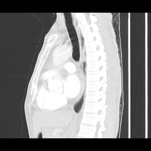 Accessory left horizontal fissure with lingular pneumonia (Radiopaedia 53763-59843 Sagittal lung window 35).jpg